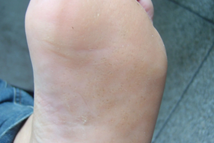 掌跖点状角化前跖症状图