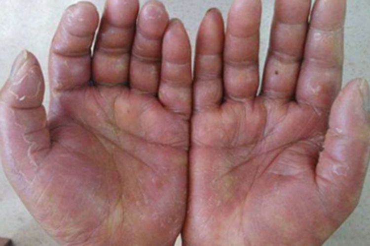 手足综合征手掌红肿图