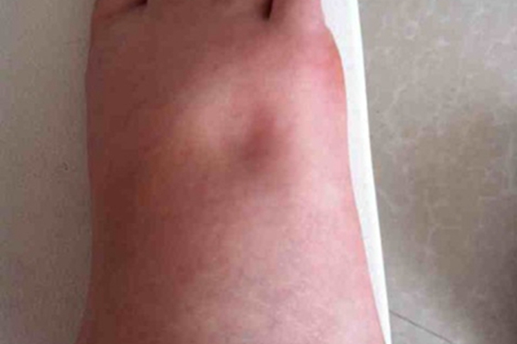 维生素E缺乏症水肿图