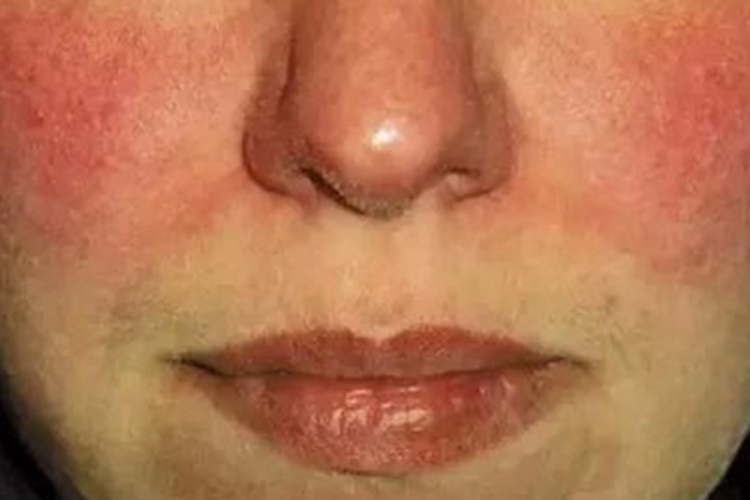 红斑毛细血管扩张型酒糟鼻红斑图