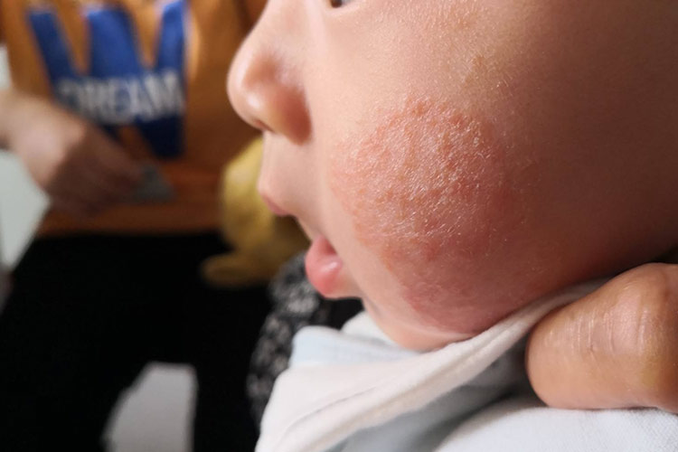 婴儿期-特应性皮炎图片