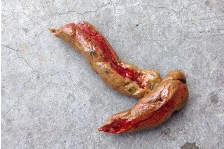 溃疡性结肠炎图 溃疡性结肠炎图