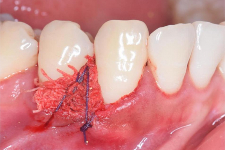 碘仿纱条覆盖创面图 碘仿纱条覆盖创面图