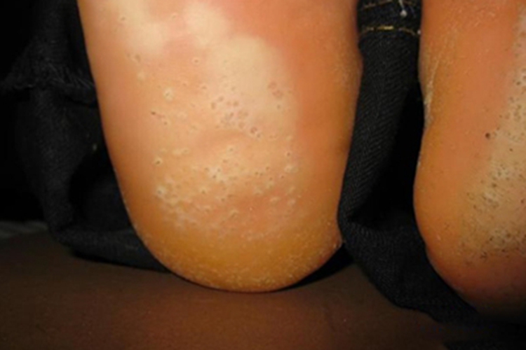 沟状跖部角质松解症脚后跟小坑图 沟状跖部角质松解症脚后跟小坑图