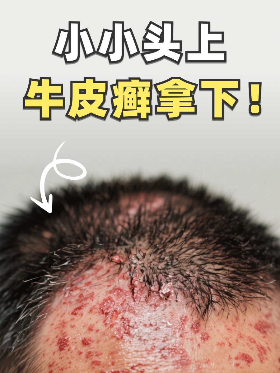 头皮牛皮癣怎么自愈？医生给你实用建议！