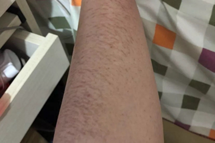 萎缩纹小腿上有横着的裂纹图