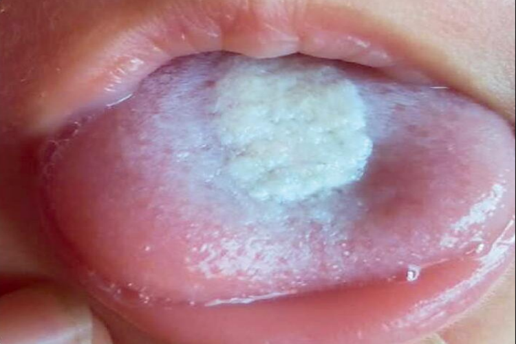 小孩积食舌苔白厚图