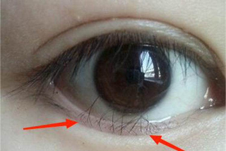 倒睫睫毛倒向眼睛里图