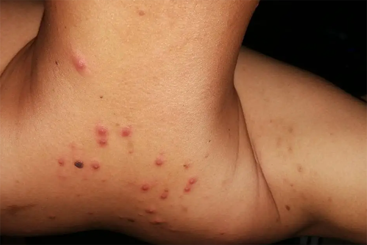 人身上的羊毛疔图