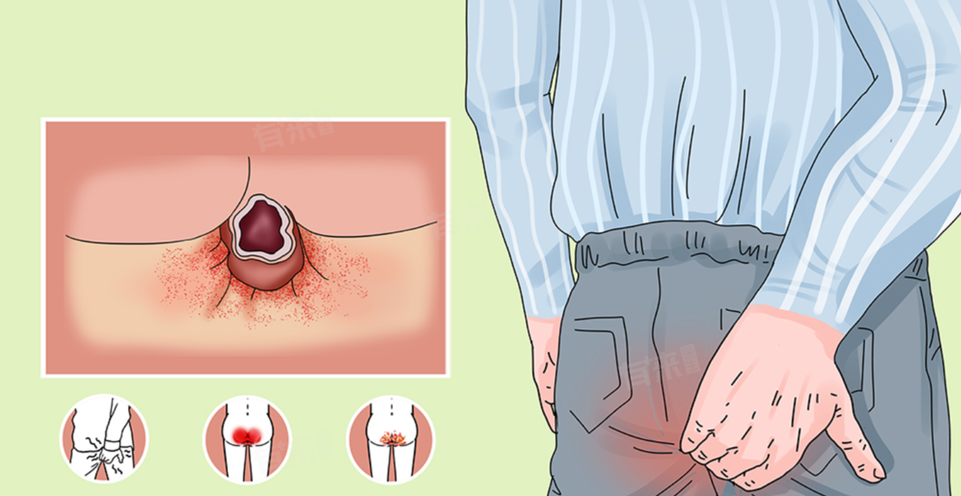 屁眼流水-有来医生