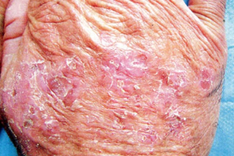 老年性角化病手背皱缩脱皮图 老年性角化病手背皱缩脱皮图