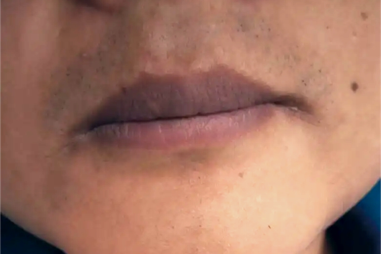 维生素B1缺乏症嘴唇症状图
