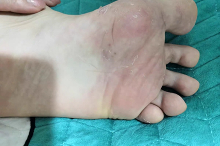 水疱型足癣脚底发红脱皮图