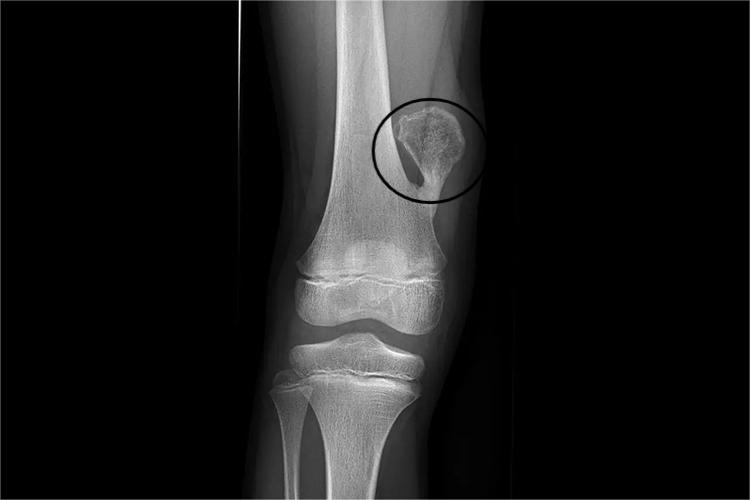 骨软骨瘤影像图