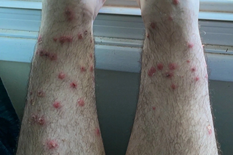 恙螨皮炎腿结痂图