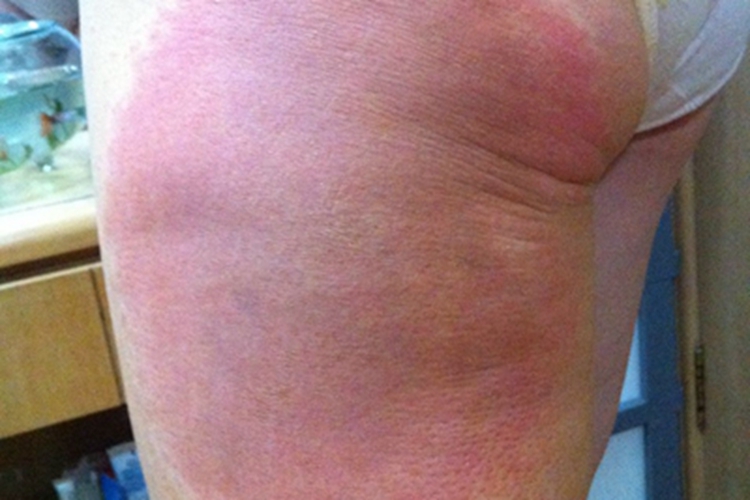 油漆皮炎左侧大腿后面皮肤发红图