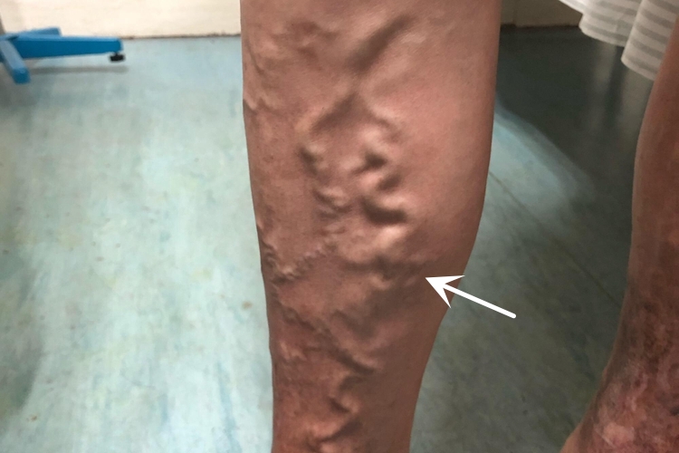 Ⅱ度静脉曲张图 Ⅱ度静脉曲张图