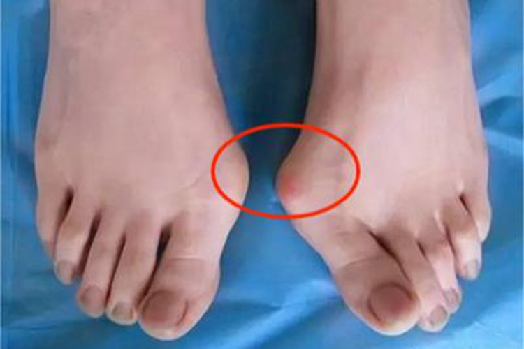 拇趾滑囊炎症状图