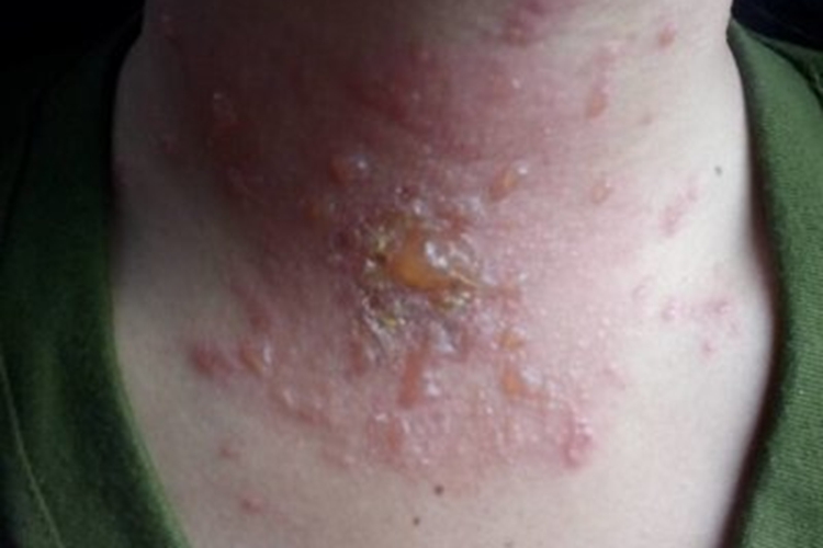 脖子带状疱疹图