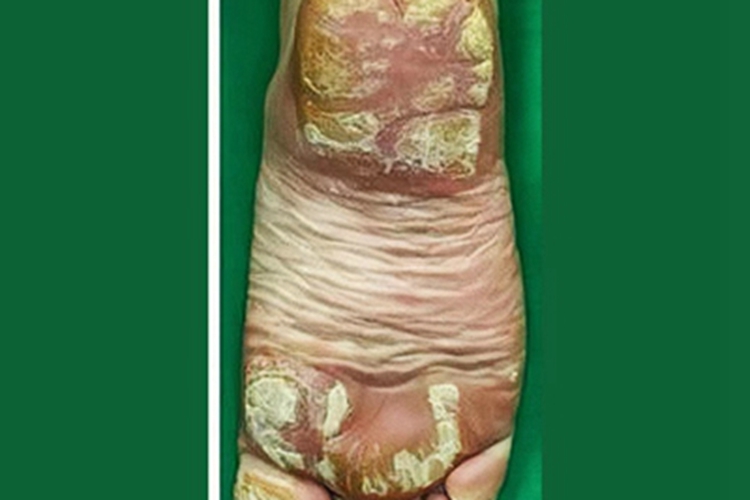 点状掌跖角化病皮肤增厚图 点状掌跖角化病皮肤增厚图