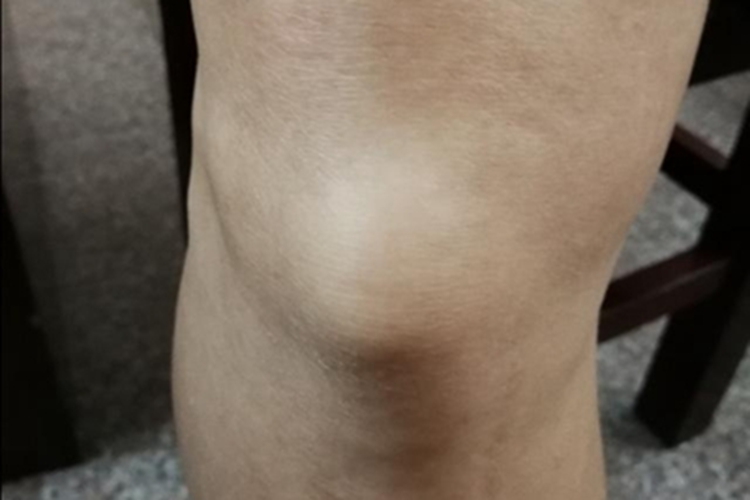 上皮样肉瘤膝盖症状图