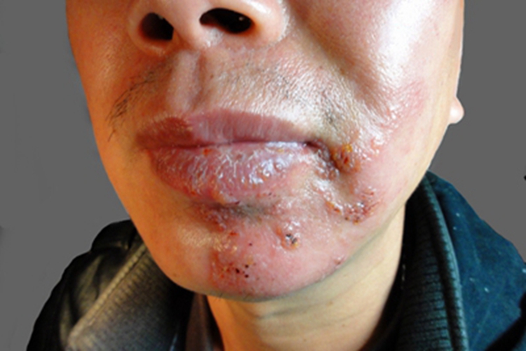 口腔带状疱疹口周水疱图 口腔带状疱疹口周水疱图