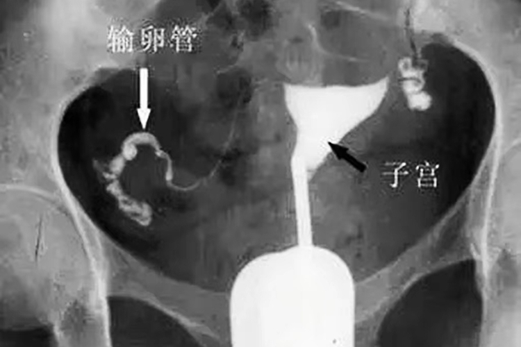 X线下正常子宫输卵管造影图
