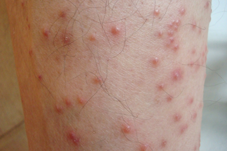 蠓性皮炎红肿图