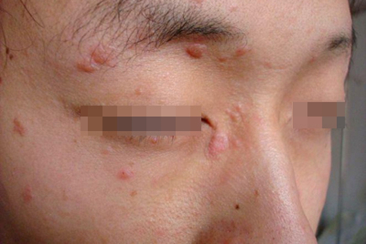 扁平疣眼周疙瘩图