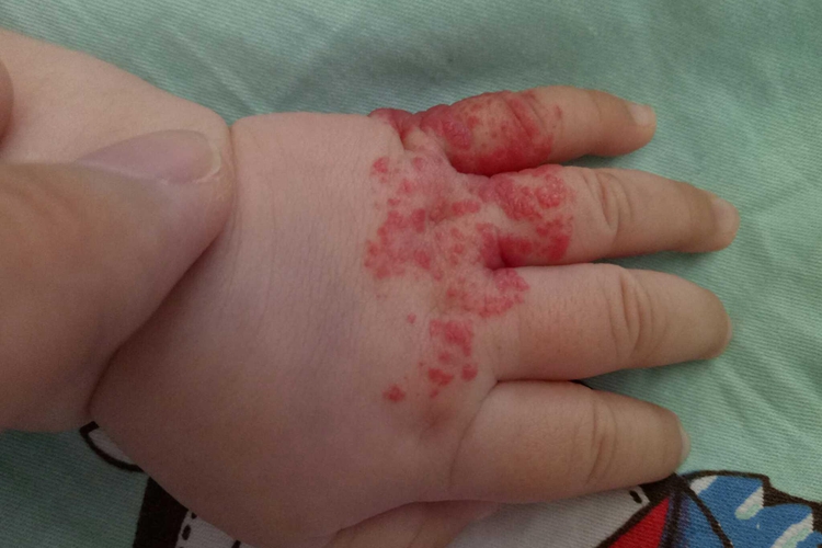 毛细血管瘤手指斑图