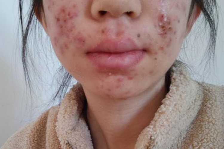 痘痘加重皮疹图