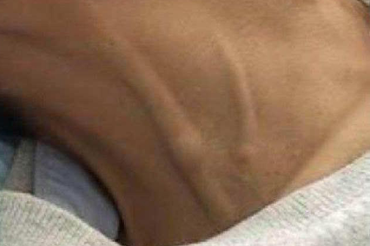 生理性颈静脉充盈图