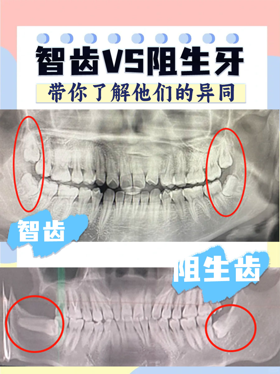 智齿VS阻生牙：一文带你了解它们的异同