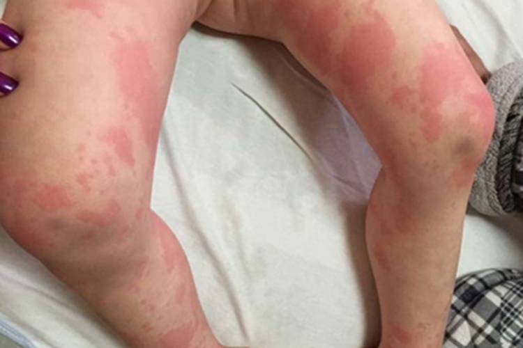 小儿海鲜过敏腿部症状图
