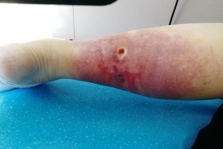 被蜱虫咬后十天伤口组织坏死图