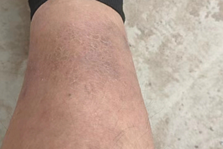 慢性湿疹小腿皮肤粗糙图