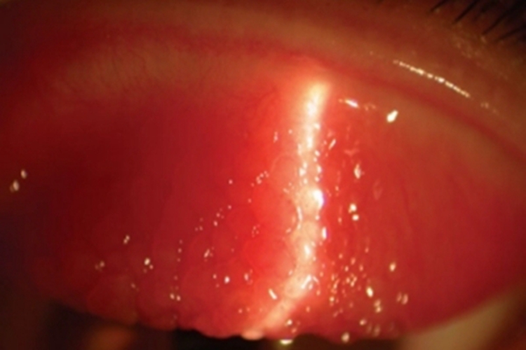 腺病毒性角结膜炎结膜小水疱图