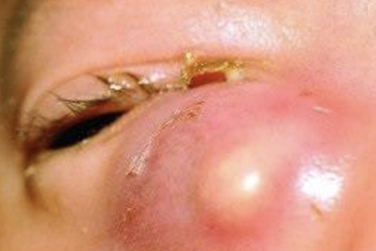 眶隔前蜂窝织炎眼部脓包图