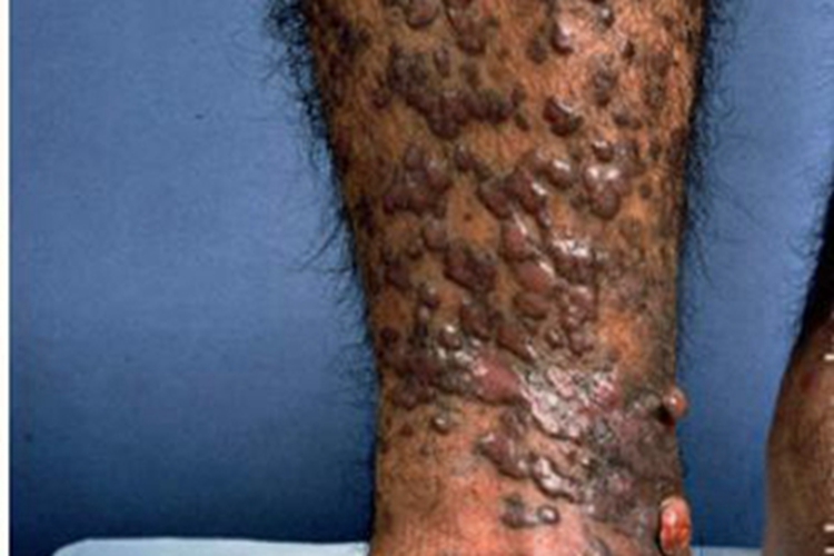 卡波西肉瘤小腿疙瘩图