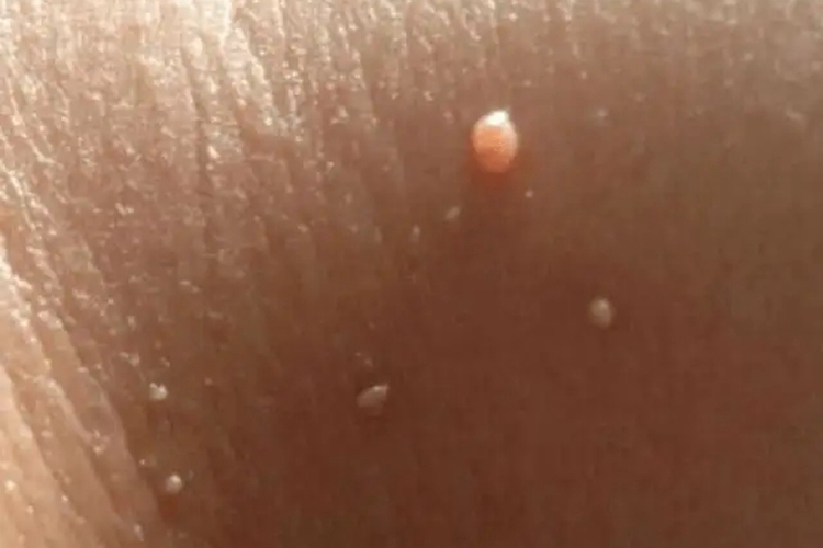 腋下皮肤纤维瘤图