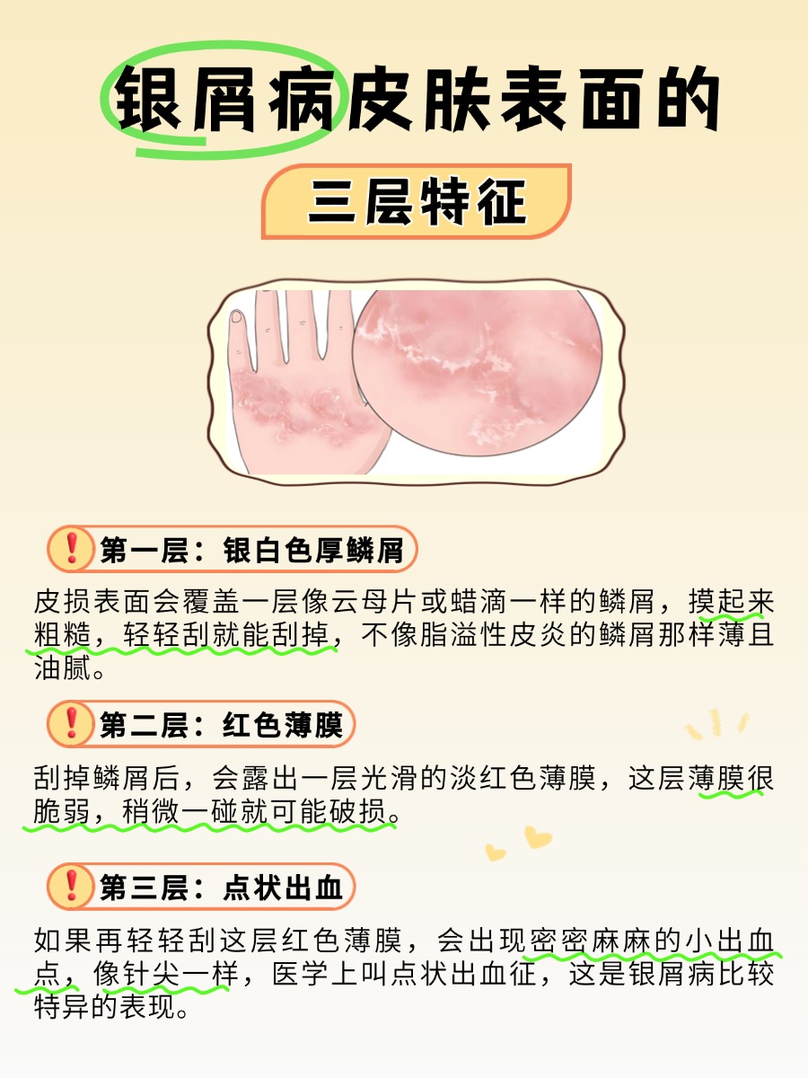银屑病症状和图片，医生帮分辨！