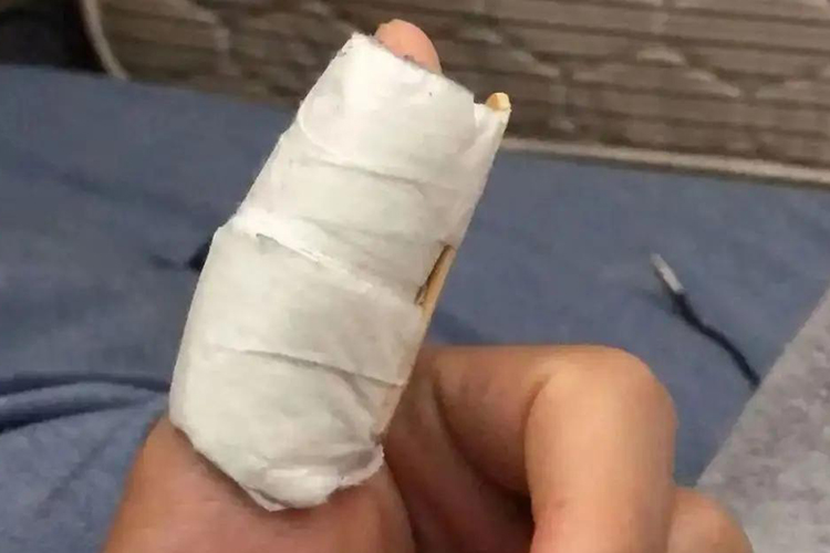 大拇指骨裂外固定图