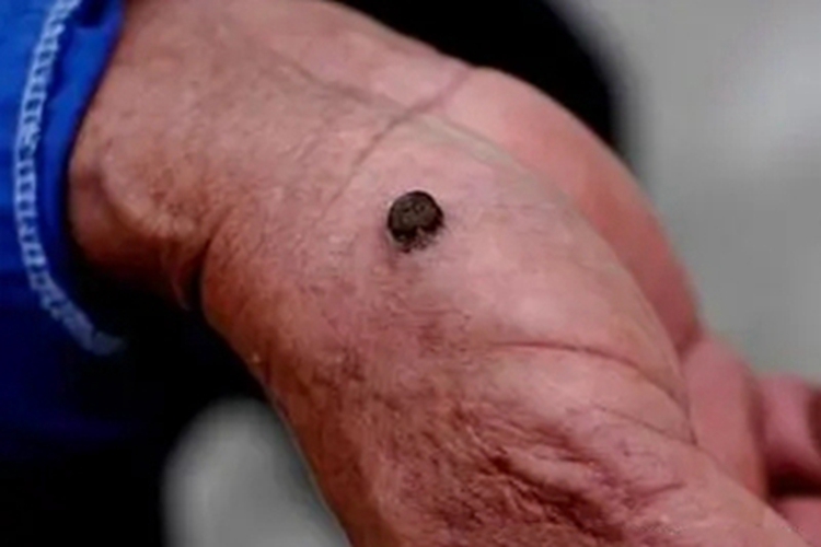 恶性黑色素瘤手部结节图