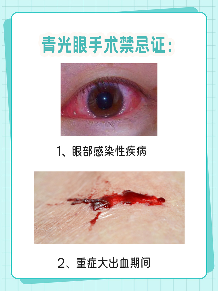 青光眼手术几天可以出院?快来了解!