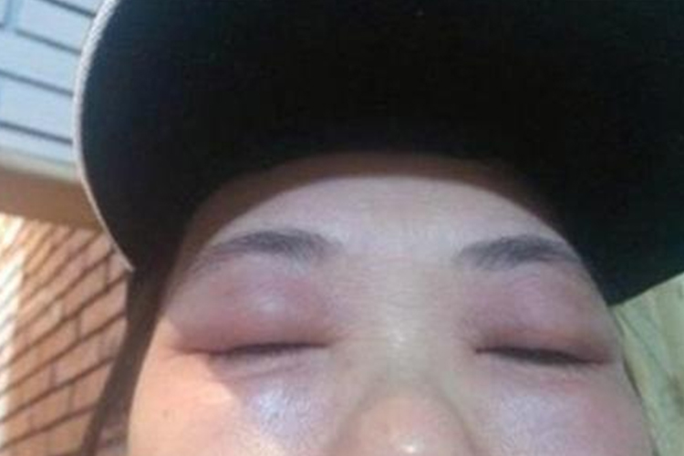 肾炎眼睑浮肿图