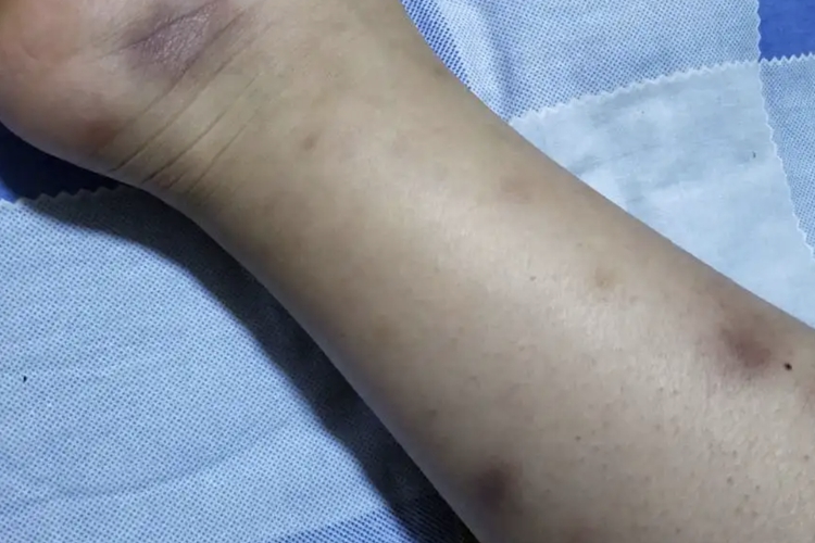 结节性红斑图 结节性红斑图