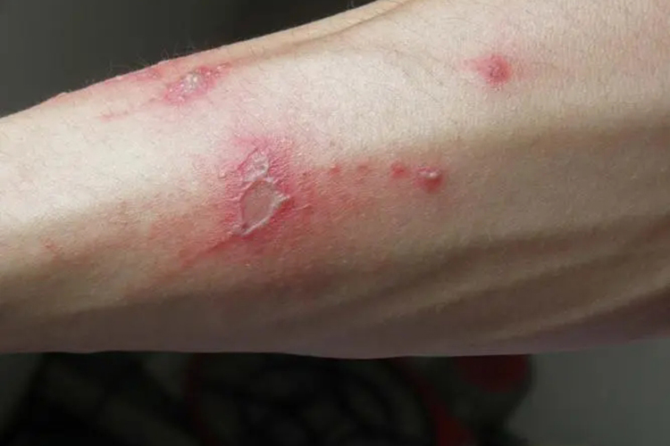 艾滋病初期手臂上单纯疱疹图