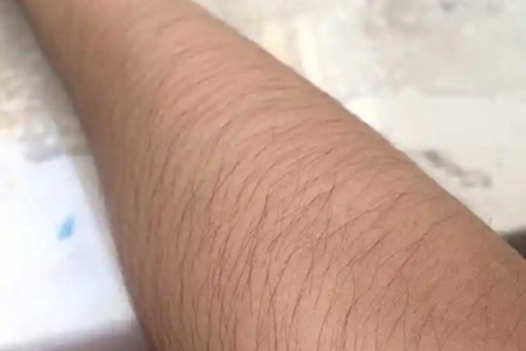 女性多毛症胳膊症状图