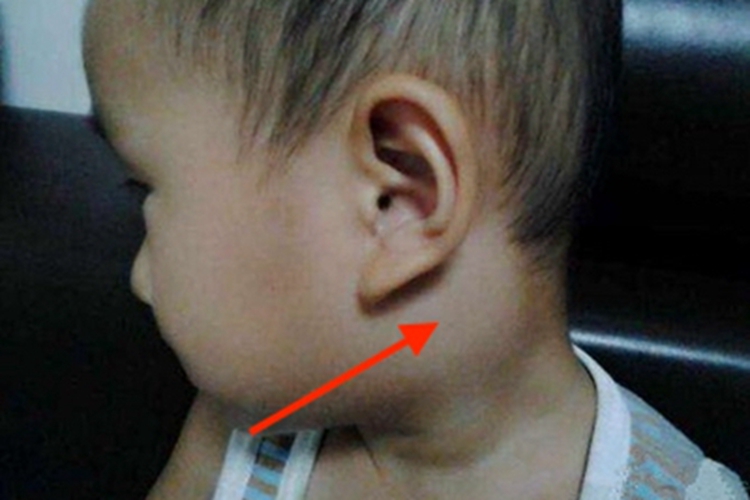 流行性腮腺炎耳后肿块图