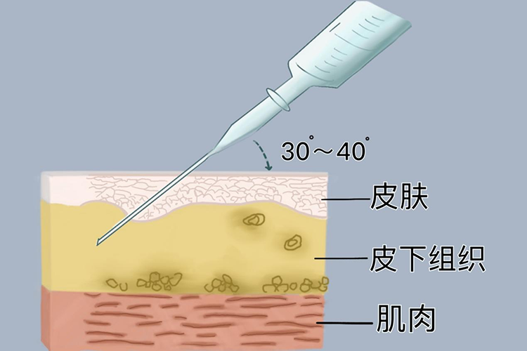 皮下注射示意图